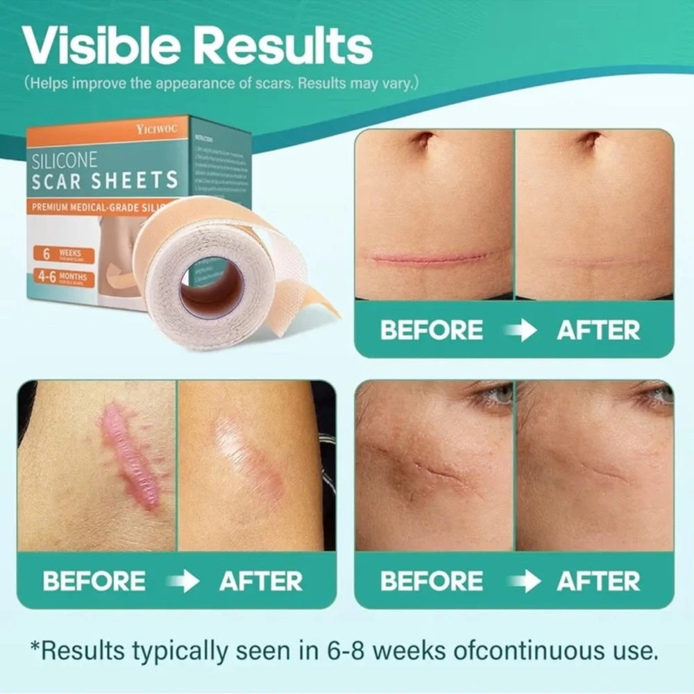 Silicone Gel patch Scar removal tape